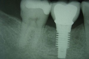 implant2c   