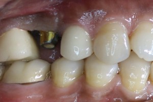 implant3b   